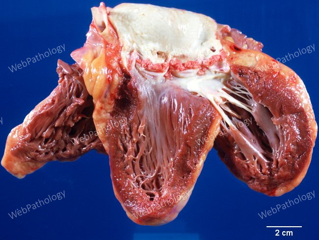 Heart_Endocarditis_NonBacterialThrombotic10A_Aortic (1).jpg